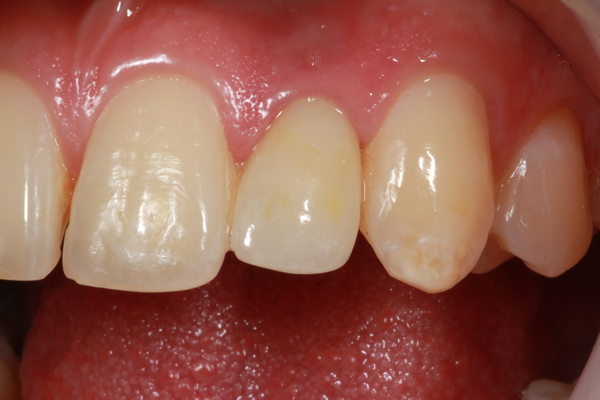 #10 implant e.max Crown over Custom Zirconia Abutment