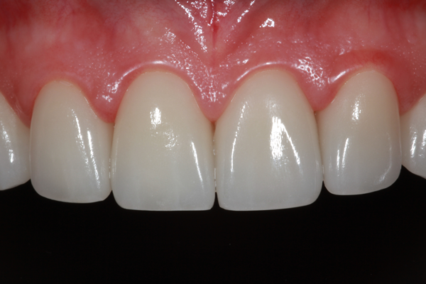 #4-12 e.max Veneers