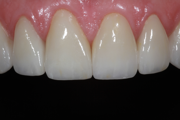 #6-11 e.max Veneers, #5 & #7 e.max Crowns