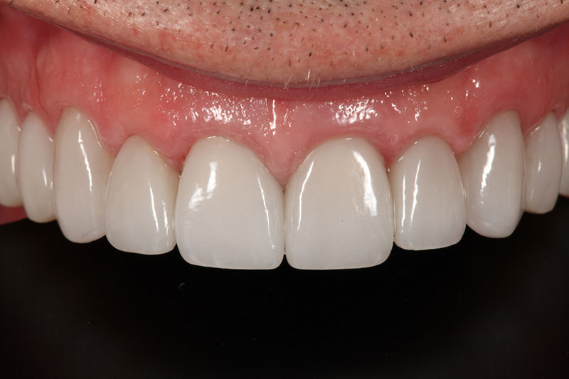 #6-11 Crowns & Veneers